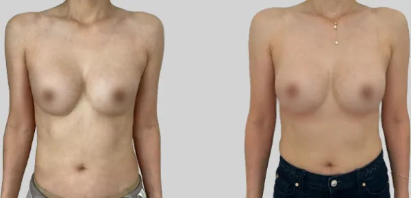 Before/After