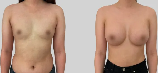 Before/After