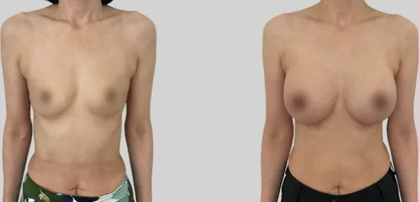 Before/After