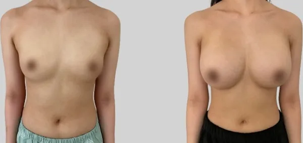 Before/After