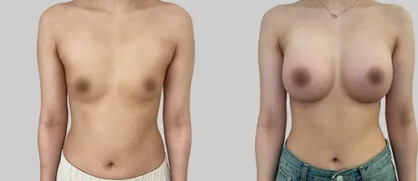 Before/After
