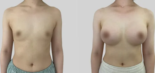 Before/After