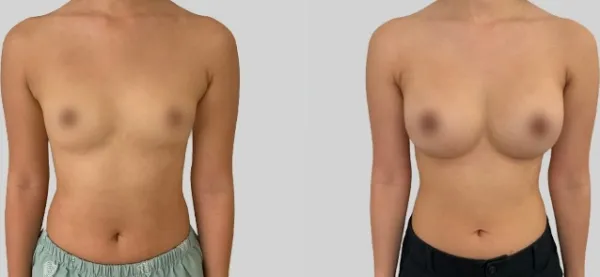 Before/After