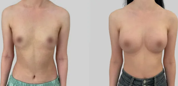 Before/After