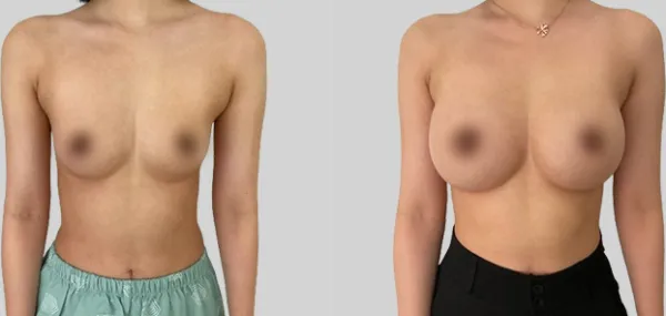 Before/After