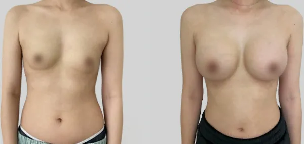 Before/After