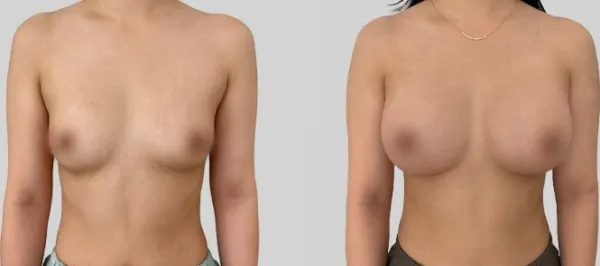 Before/After