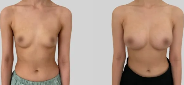 Before/After