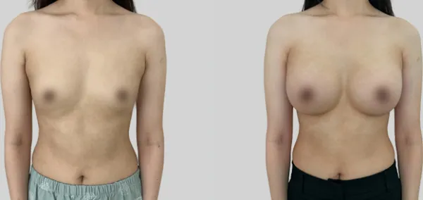 Before/After
