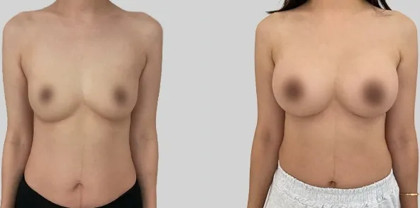 Before/After