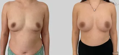Before & After