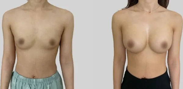 Before/After