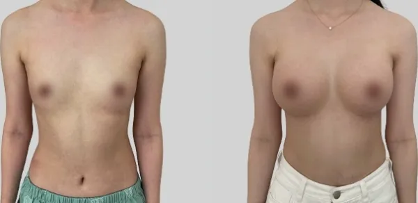 Before/After