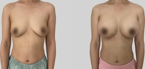 Before/After