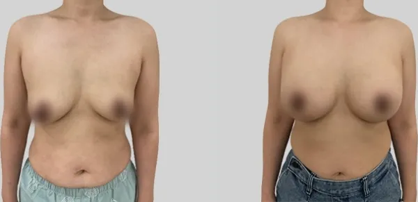 Before/After