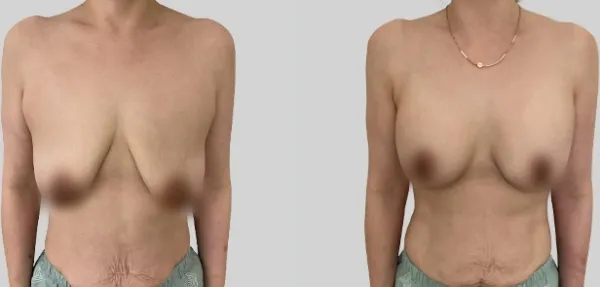 Before/After