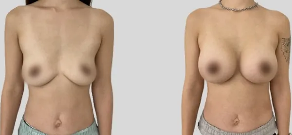 Before/After