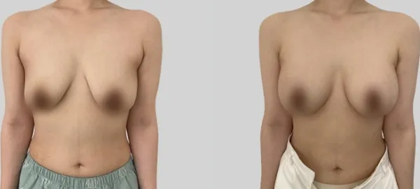 Before/After