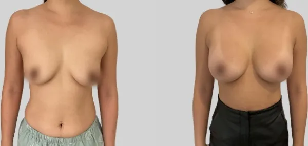 Before/After