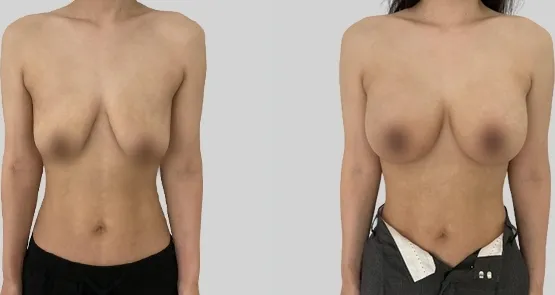 Before/After