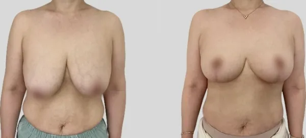 Before/After