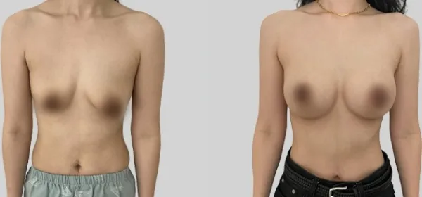 Before/After