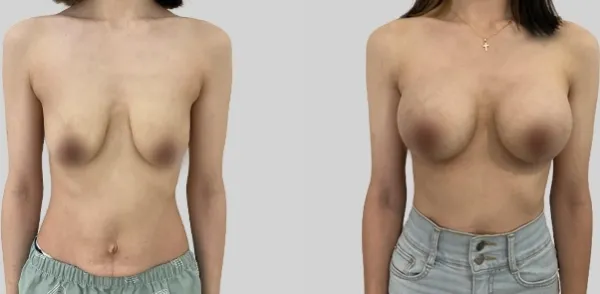 Before/After
