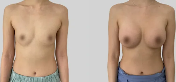 Before/After