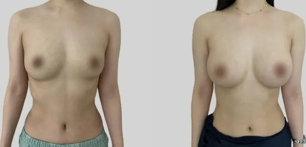 Before/After