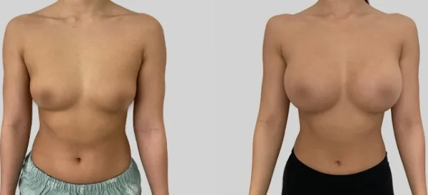 Before/After