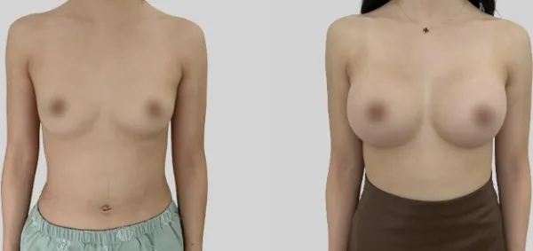 Before/After