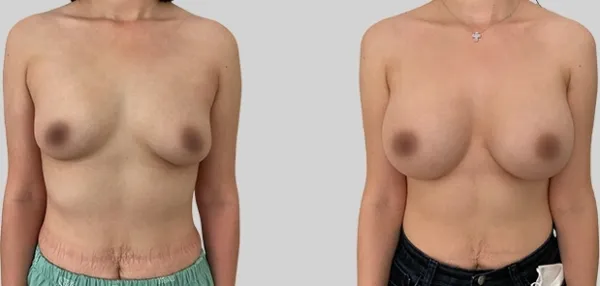 Before/After