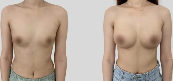 Before/After