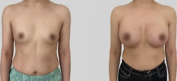Before/After