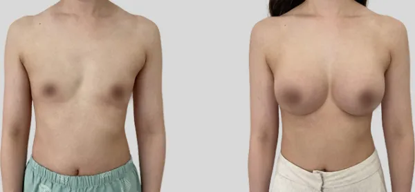 Before/After
