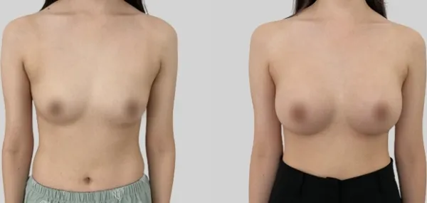 Before/After