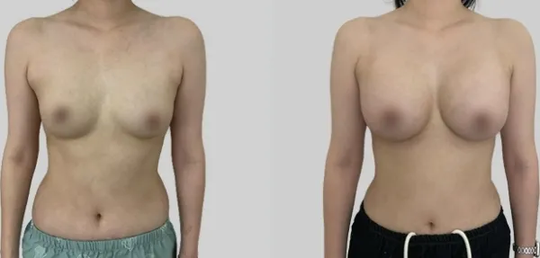 Before/After
