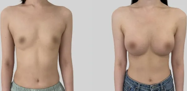 Before/After