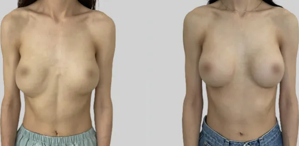 Before/After