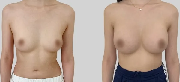 Before/After