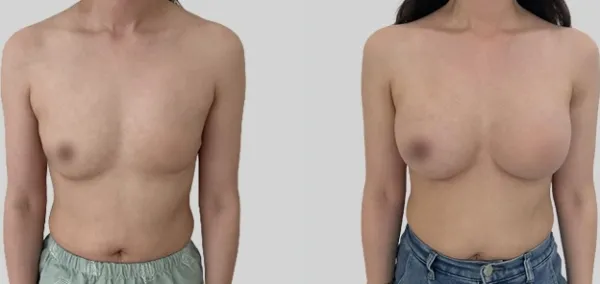 Before/After