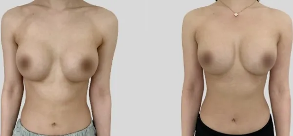 Before/After