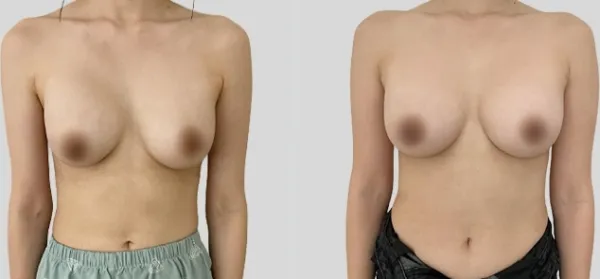 Before/After