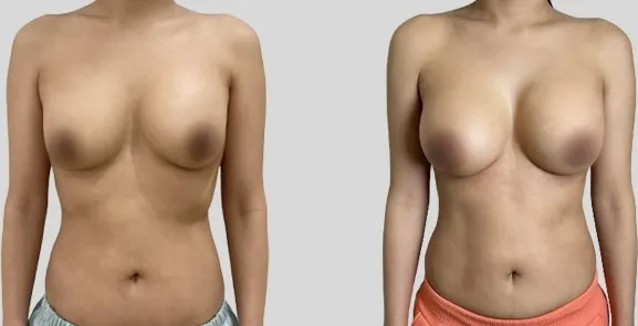 Before/After