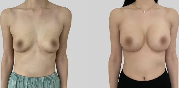 Before/After