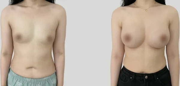 Before/After