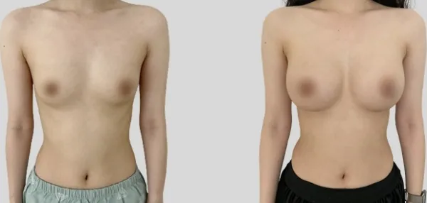 Before/After