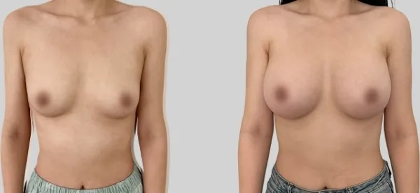 Before/After