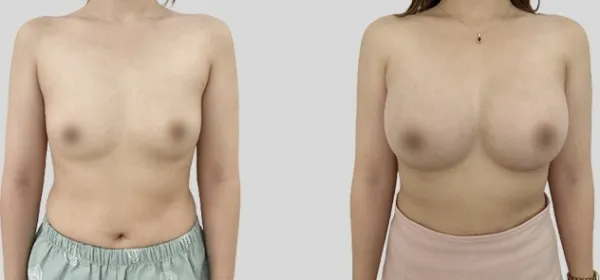 Before/After