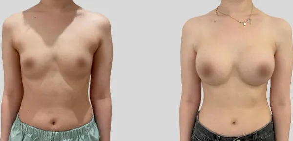 Before/After
